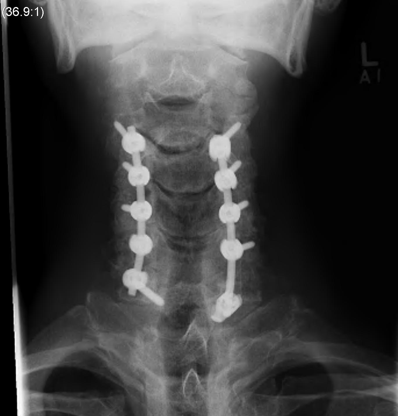 Cervical Myelopathy Posterior Decompression Instrumentation